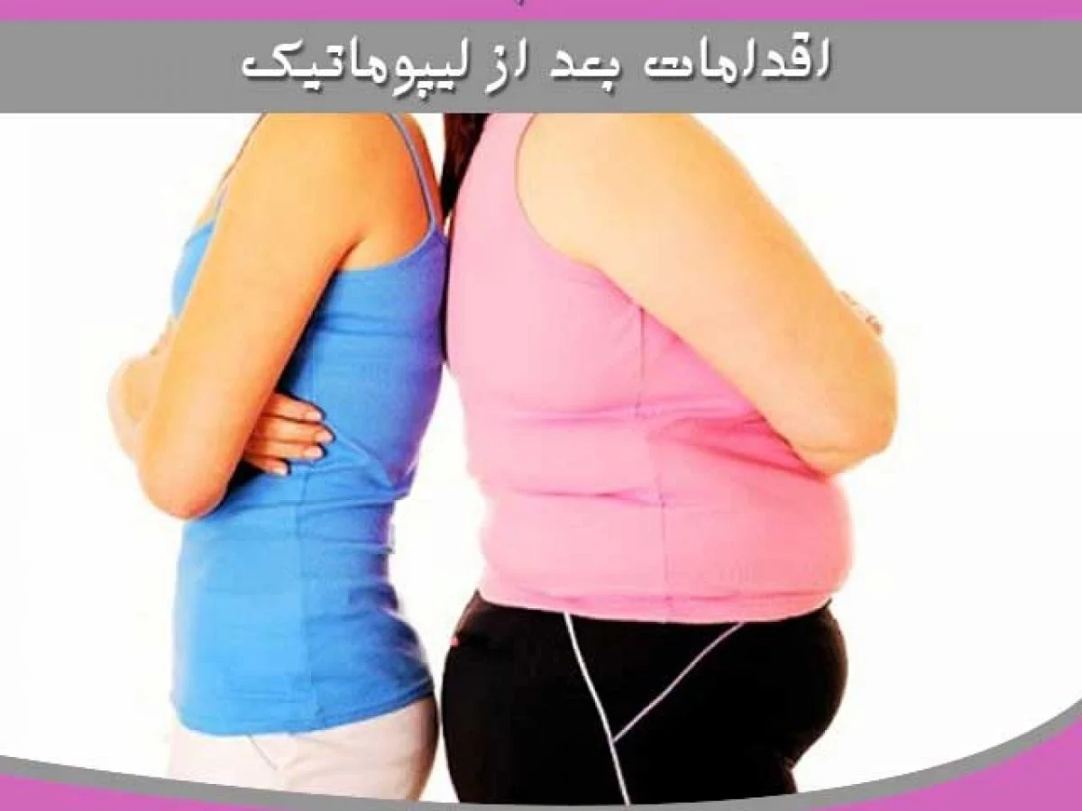 مراقبتهای بعد از جراحی لیپوماتیک
