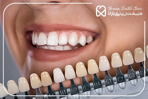 پر کاربردترین سوالات درباره لمینت دندان
