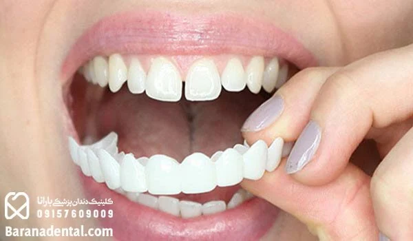 پر کاربردترین سوالات درباره لمینت دندان