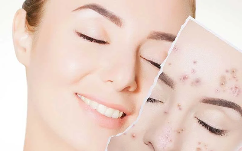 نحوه استفاده از کرم پودر برای تسریع در بهبود جوش های پوست