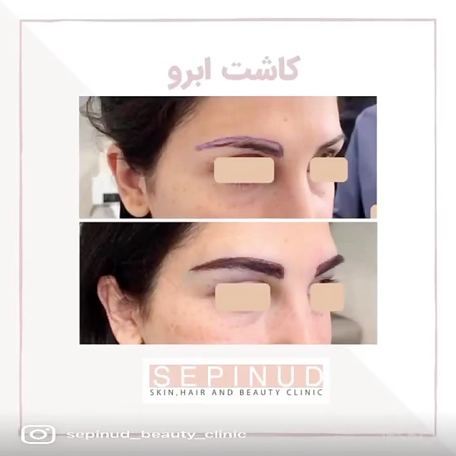 کاشت ابرو به روش FIT - مزایا و معایب، روش کار و هزینه