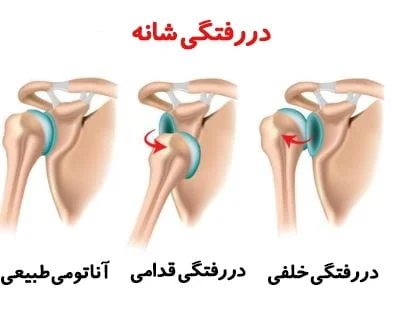 دکتر فوق تخصص شانه در تهران