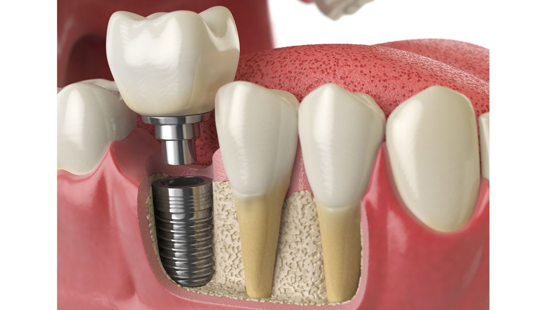 ایمپلنت دندان |ایمپلنت دندان کرج