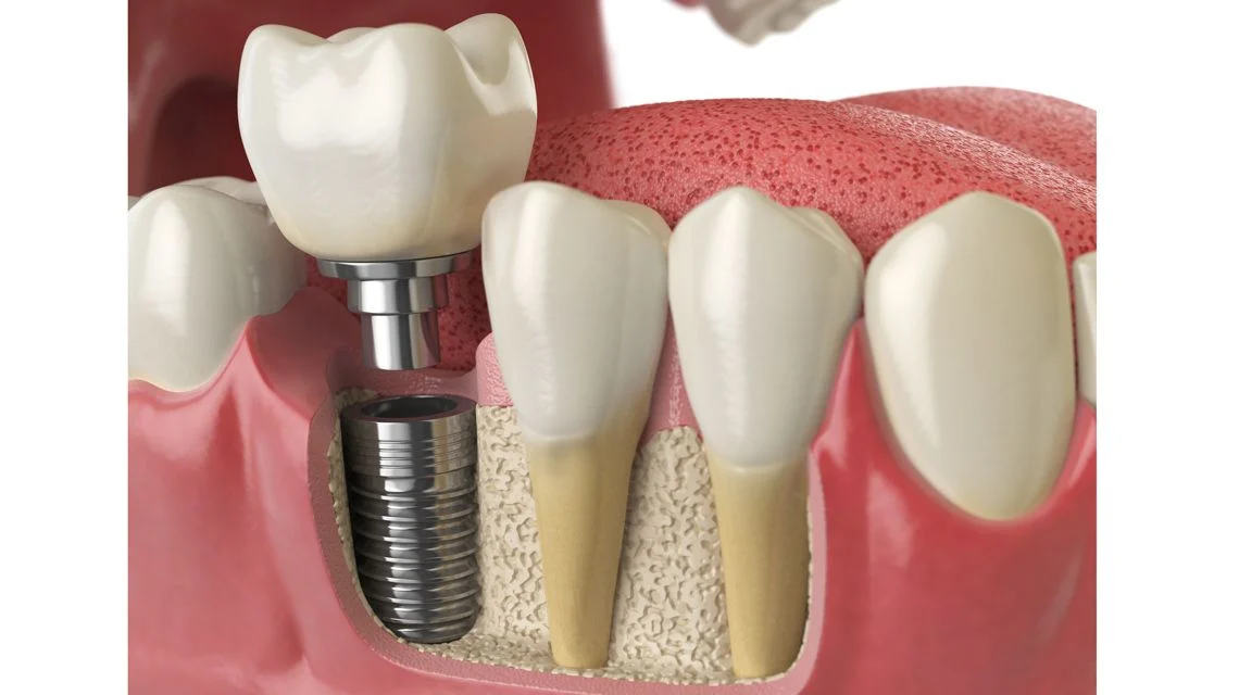 چگونه مناسب ترین کلینیک برای ایمپلنت دندان را انتخاب کنیم؟
