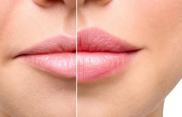مراقبت های بعد از تزیق ژل لب