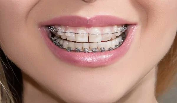 چرا درمان ارتودنسی حائز اهمیت است؟