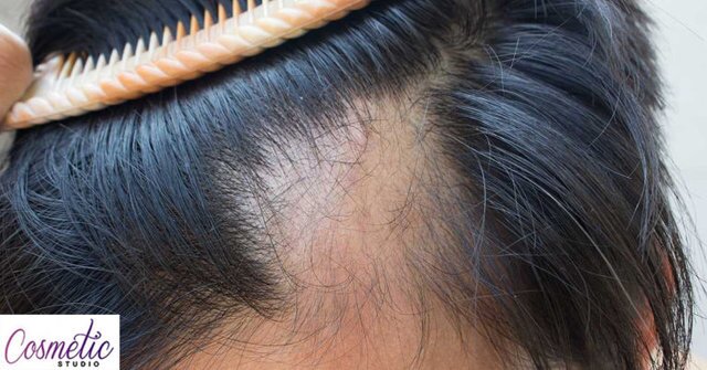 آیا می‌توان از ریزش مو جلوگیری کرد؟