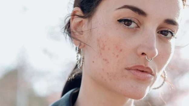 تأثیر آلرژیها بر پوست و راهکارهای مقابله