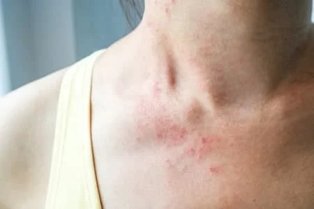 عوارض پوستی رژیم کتوژنیک
