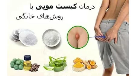 تخلیه کیست مویی در خانه