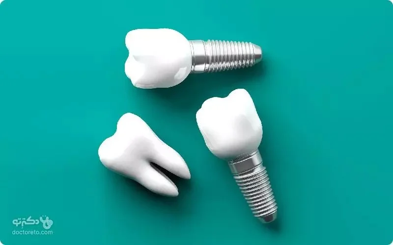 بهترین ارائه دهندگان خدمات ایمپلنت دندان با هزینه مناسب + تخفیف در دکترتو کلینیک