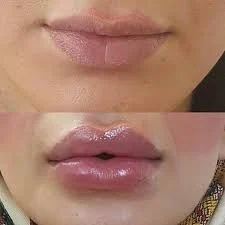 بهترین دکتر برای تزریق فیلر در اصفهان
