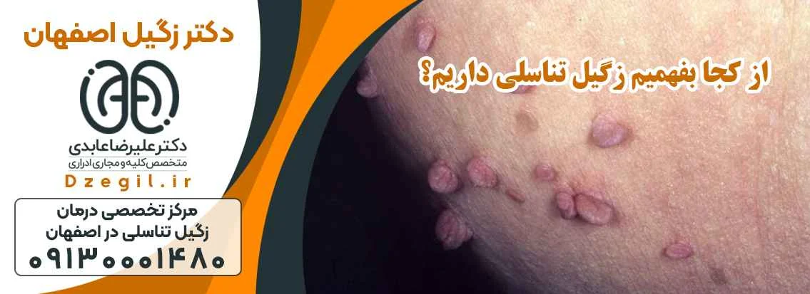 زگیل |زگیل تناسلی بهترین دکتر متخصص درمان زگیل در اصفهان