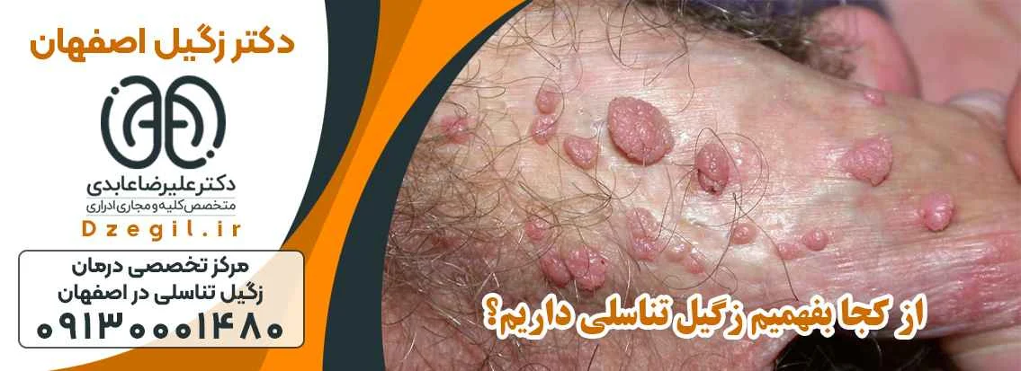 زگیل |زگیل تناسلی دکتر زگیل اصفهان