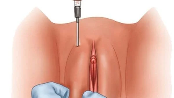 آیا عمل چربی واژن خوب است؟