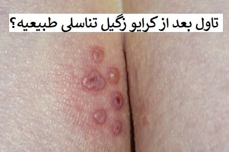 چند روز بعد از کرایو زگیل می افتد؟