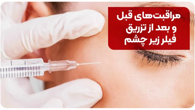 مراقبت های قبل و بعد از تزریق فیلر زیر چشم