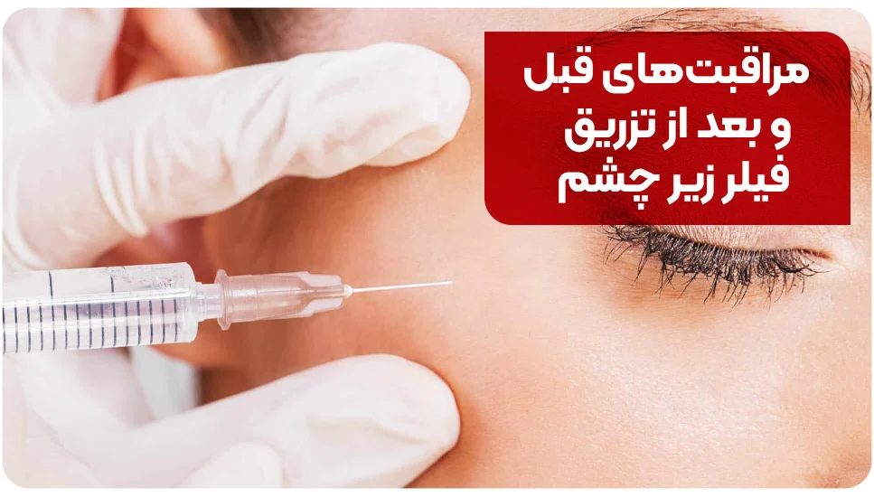 مراقبت های قبل و بعد از تزریق فیلر زیر چشم