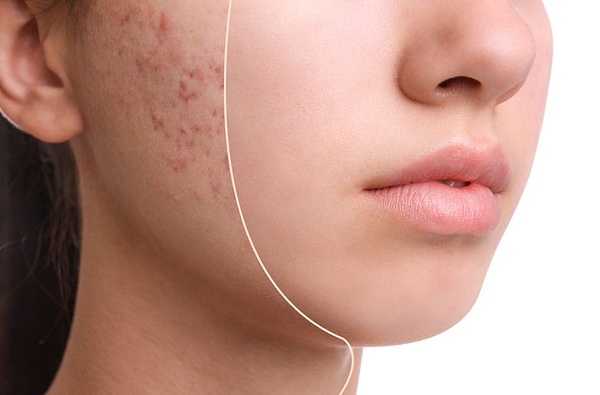 برای جلوگیری از جوش صورت چه کنیم؟