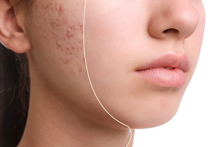 برای جلوگیری از جوش صورت چه کنیم؟