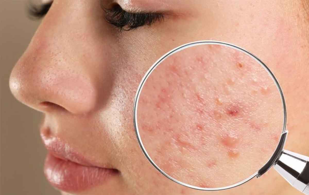 برای جلوگیری از جوش صورت چه کنیم؟
