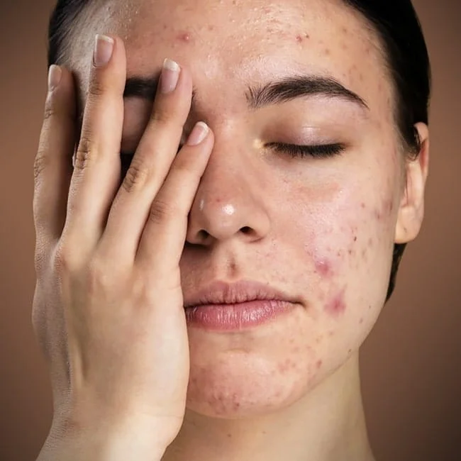 برای جلوگیری از جوش صورت چه کنیم؟