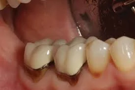 چرا روکش دندان سیاه می شود؟