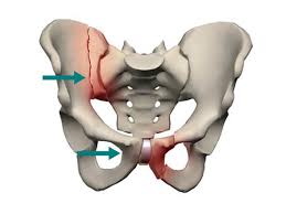 درد لگن چگونه درمان می شود؟